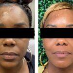 Microneedling for scar revision